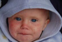 Measles Outbreak In Brighton