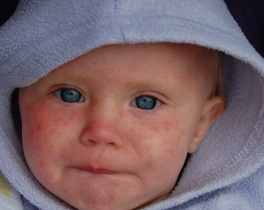 Measles Outbreak In Brighton
