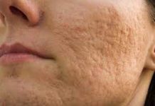 Is the Brighton Winter Causing You to Get Acne?