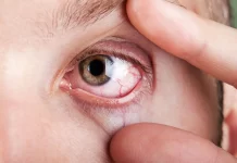 Dry eyes: Cause, treatment, and prevention