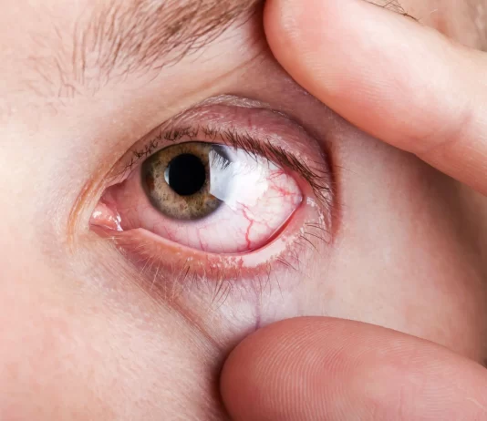 Dry eyes: Cause, treatment, and prevention