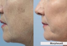 Morpheus8 Before and After: Transforming Skin With Radiofrequency Microneedling