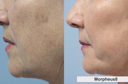 Morpheus8 Before and After: Transforming Skin With Radiofrequency Microneedling