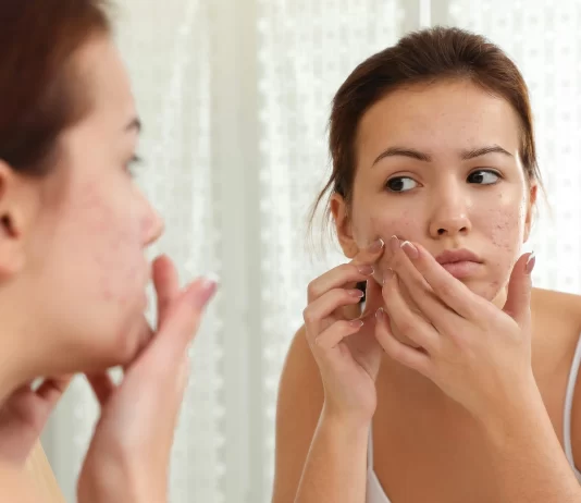 Treating Acne Scars: Discover Clear and Radiant Skin
