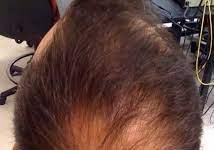 2024’s Top 10 Best Hair Transplant Clinics in Turkey and Hair Transplant Costs