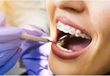 Braces Prices: Which Type is Cheaper?