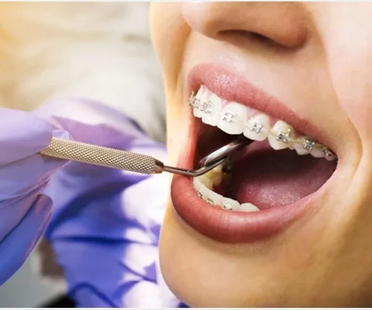 Braces Prices: Which Type is Cheaper?