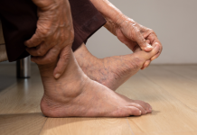 Weekend Feature- How Gout is now spreading to the masses
