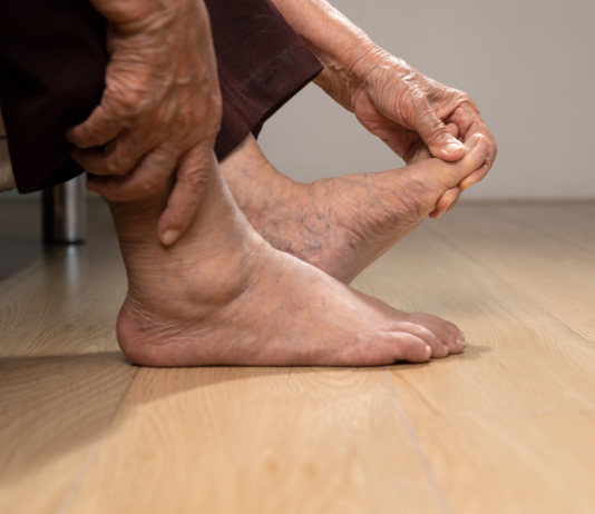 Weekend Feature- How Gout is now spreading to the masses