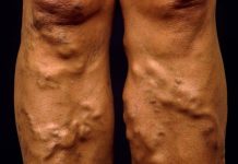 Are varicose veins just cosmetic, or should you be concerned?